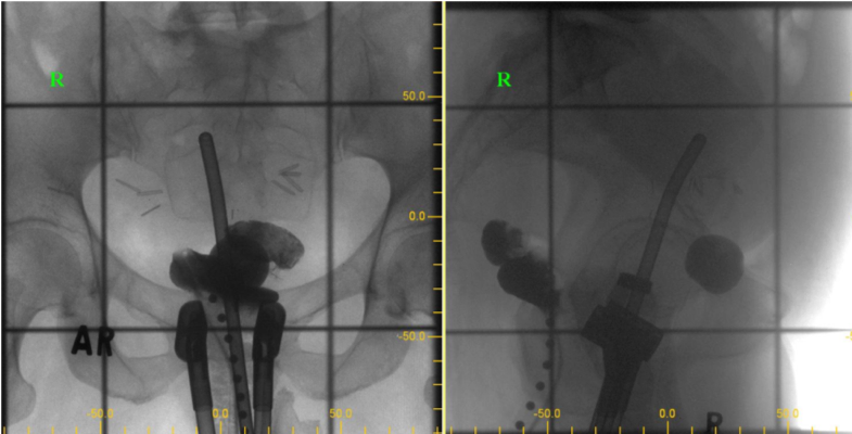 2D X-ray imaging (in OR) Manchester system (Point A)