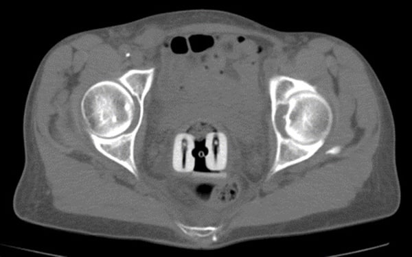 CT imaging