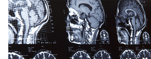 通过医科达Neuromag®诊断解决方案